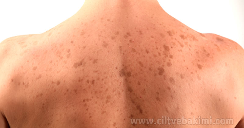 cilt-lekeleri1