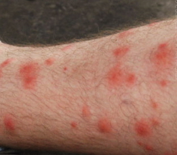 insan-piresi-isirigi